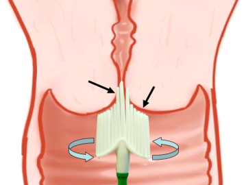 A longer bristles of the cervix sampling brush is placed into the external os and rotated around to sweep and collect cells from the cervix.