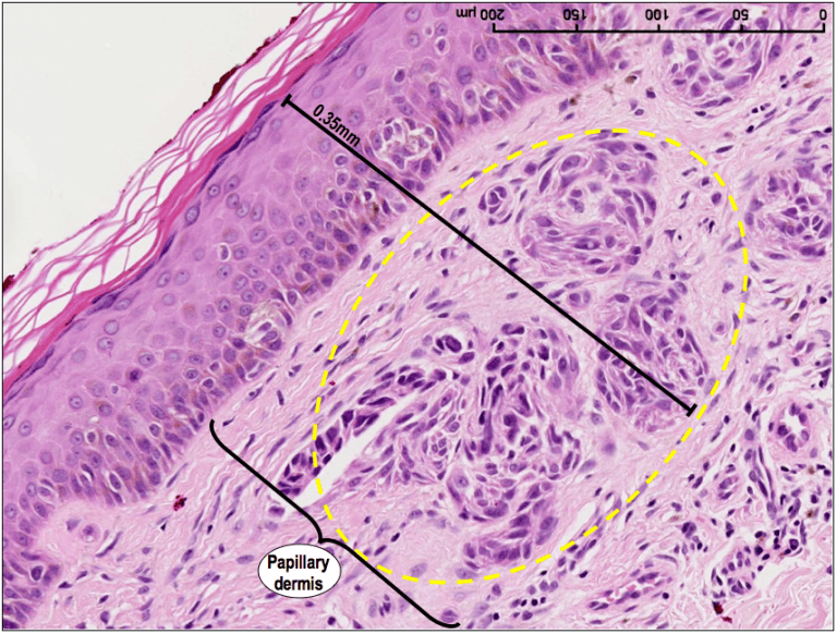 HistoQuarterly: SUPERFICIAL SPREADING MALIGNANT MELANOMA | Histology Blog
