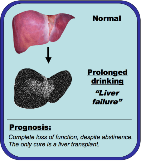 An image comparing a normal liver and complete liver failure