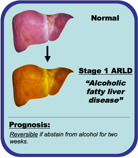 An image comparing a normal liver and alcoholic fatty liver disease