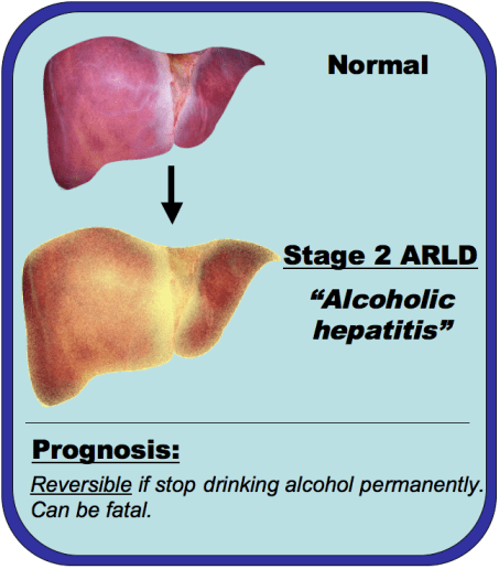 An image comparing a normal liver and alcoholic hepatitis