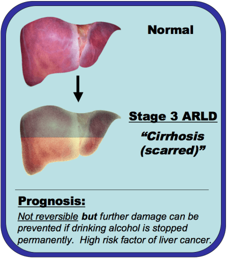 An image comparing a normal liver and a cirrhotic liver
