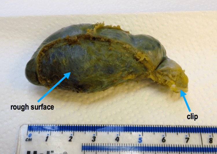 A real gallbladder. The rough under surface is the area that used to be attached to the liver. The neck of the gallbladder has a clip that was put there after it was cut from the cystic duct.