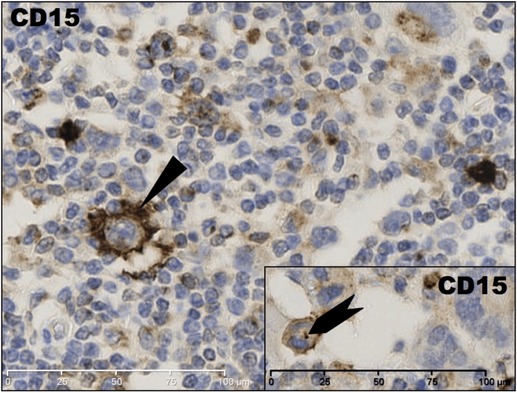 High magnification IHC CD15 demonstrating the cell membrane positivity in the large cells, and the dark dot staining of the paranuclear Golgi apparatus.
