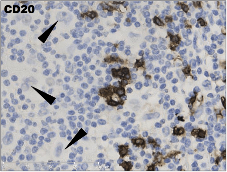 High magnification IHC CD20 demonstrating negativity in the large irregular cells.