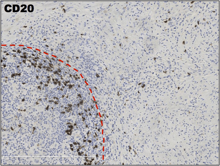 Low magnification IHC CD20 demonstrating cells of B-cell lineage, which seem sparse and confined to the periphery of the nodule only.