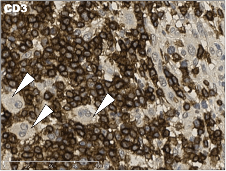 High magnification IHC CD3 showing that hugging "rosette" pattern of T-cells around the large irregular cells.