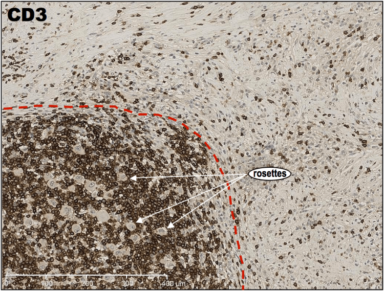 Low magnification of IHC CD3 showing a dense T-cell population within the nodules that form "rosettes" around the CD3 negative large cells.