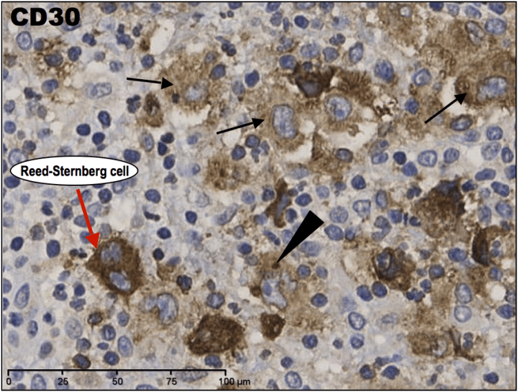 High power IHC CD30 demonstrates positivity in the Reed-Sternberg cells and mononuclear Hodgkin cells (arrows). CD30 hs a characteristic staining pattern in large-cell membranes, and the Golgi apparatus - the dark paranuclear dot (arrowhead).