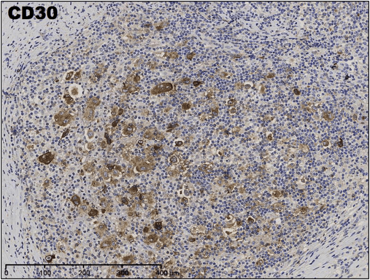 Medium magnification IHC CD30 demonstrating large cell positivity. 