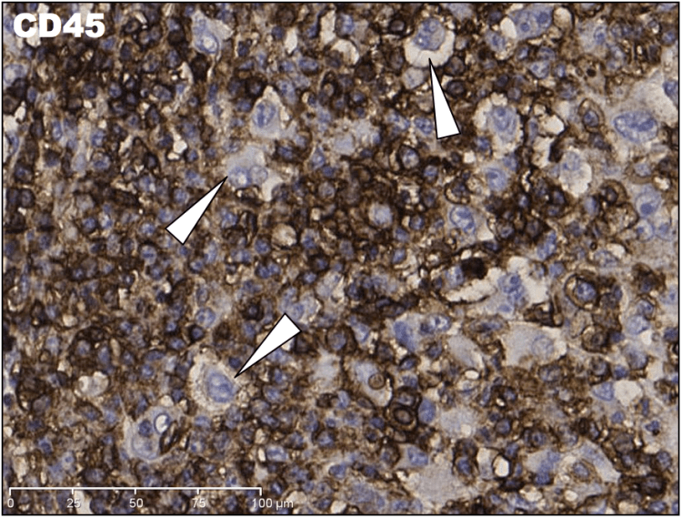 High magnification IHC CD45 demonstrating negative large cells.