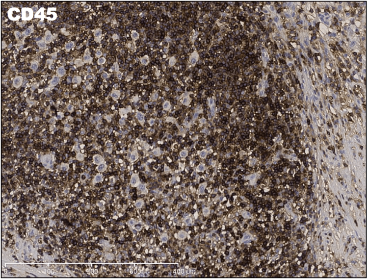 Medium magnification IHC CD45 demonstrating a not-surprising dense population of CD45 positive cells.