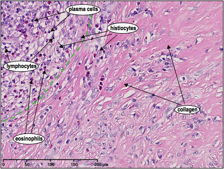 High magnification H&E showing dense collagen bands and the mixture of cells within the nodules.