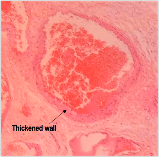 A low power H&E demonstrating an ectatic vessel with a thickened wall