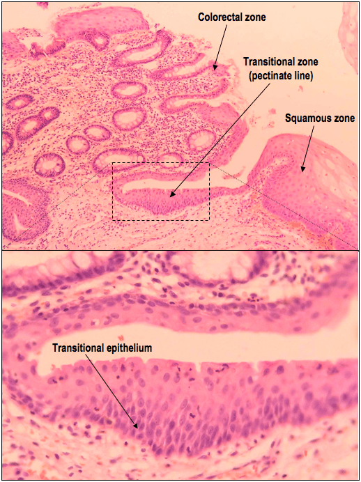 Upper: A low power H&E demonstrating the pectinate line, which is identified by the junction between the colorectal and squamous zones.