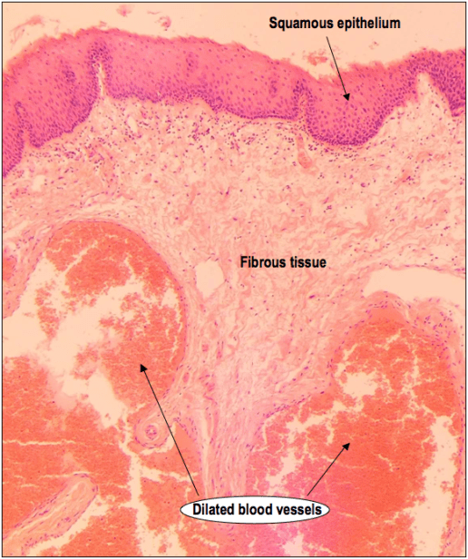 A low power H&E showing a haemorrhoid lined by squamous epithelium