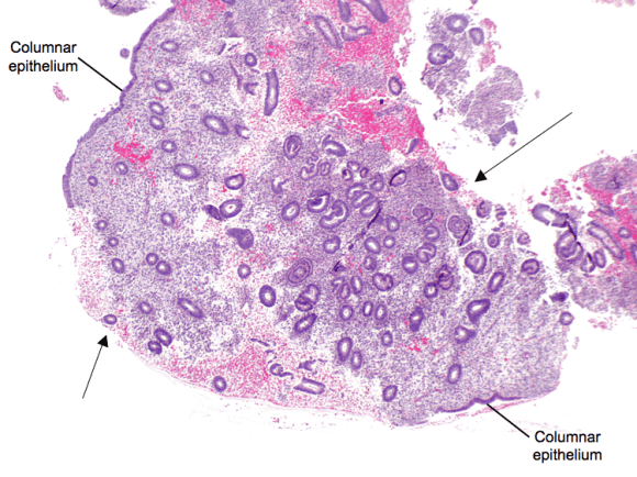 A fragment of endometrium.