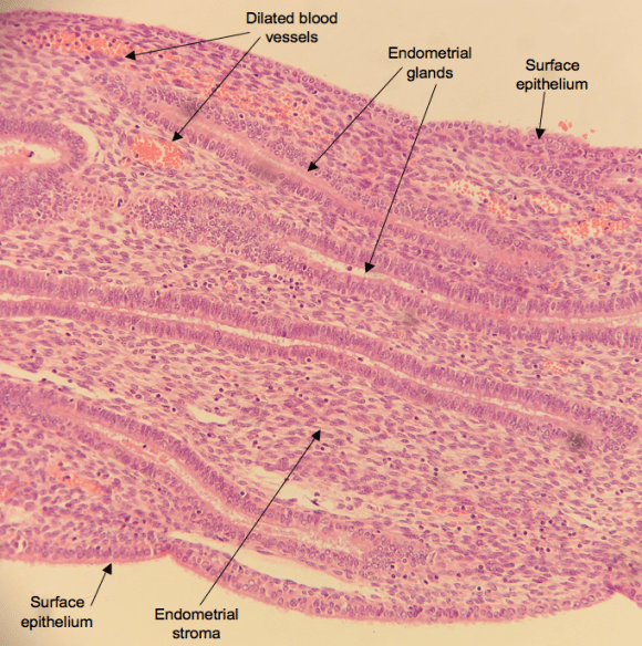 A low power H&E of a portion of endometrial polyp