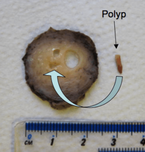 A tiny polyp is removed from the endocervical canal (arrow) in a specimen I dissected.