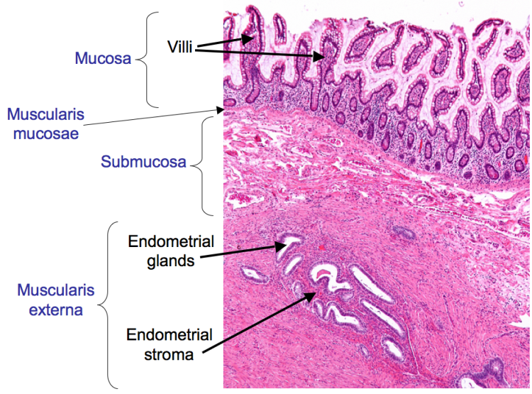 A low power H&E showing endometriosis in the duodenum