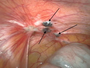 Ectopic endometrial adhesions.
