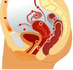 A cross-section of the female body: the red dots show areas of reported ectopic endometrial adhesions
