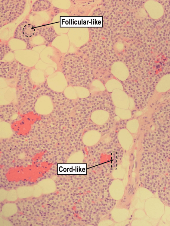 A medium power H&E showing the loose follicular-like and cord-like cell arrangements.