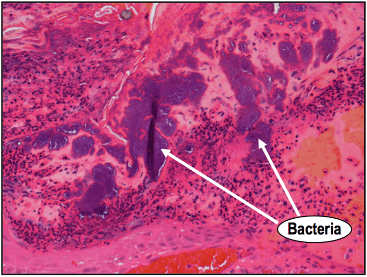 A high power H&E showing bacteria within the ulcer