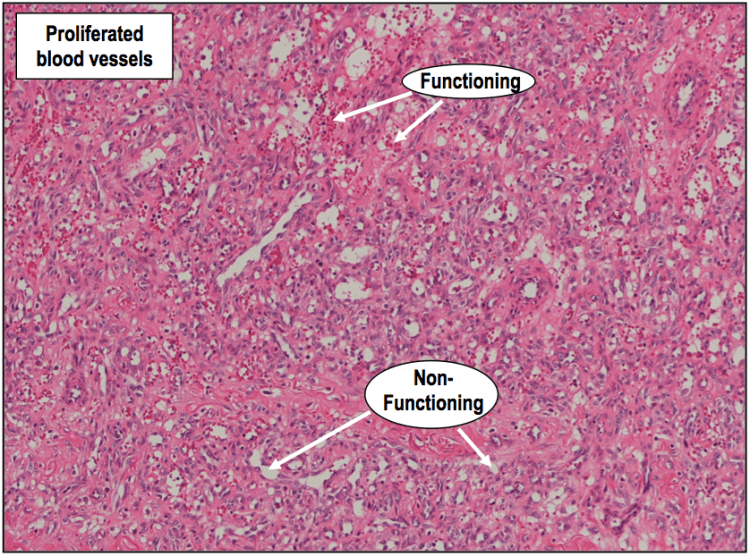 A high power H&E showing functioning and non-functioning blood vessels