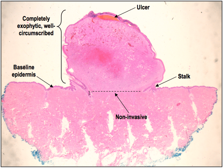 A low power H&E of a pyogenic granuloma