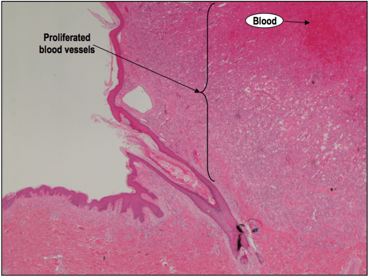 A medium power H&E showing blood vessels that have proliferate (multiplied) into many numbers.
