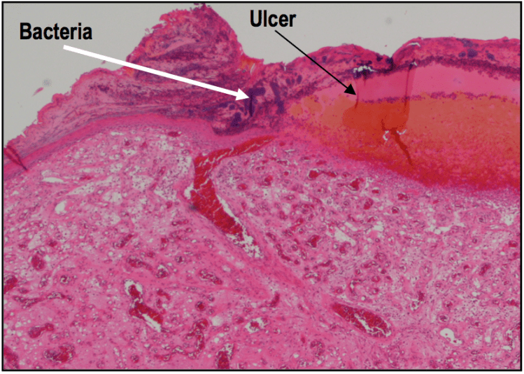 A medium power H&E showing an ulcerated pyogenic granuloma