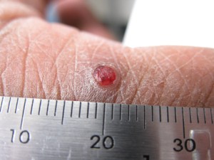 An example of a pyogenic granuloma on a finger