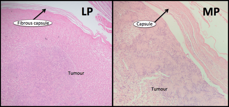 Schwannoma, H&E, histology,