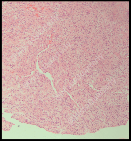 H&E, Histology, Schwannoma, Cellular schwannoma