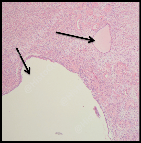 H&E, Schwannoma, histology, cysts