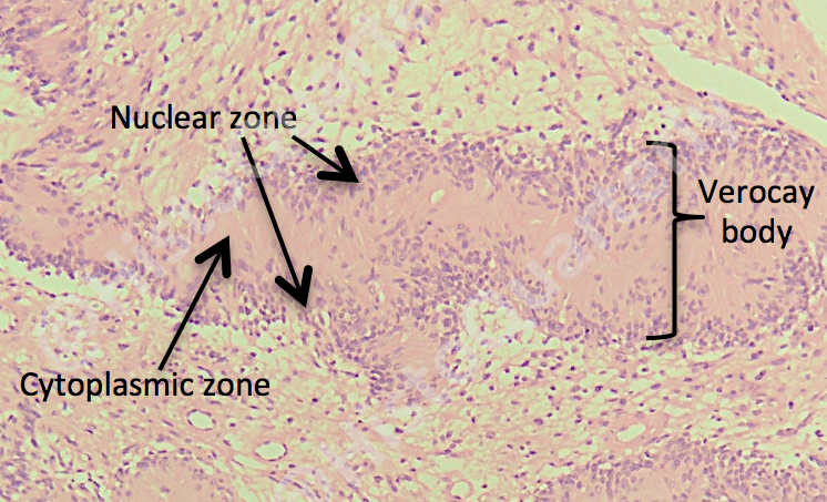 Verocay body, schwannoma, histology, H&E