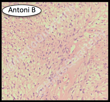 Schwannoma, histology, H&E, Antoni B